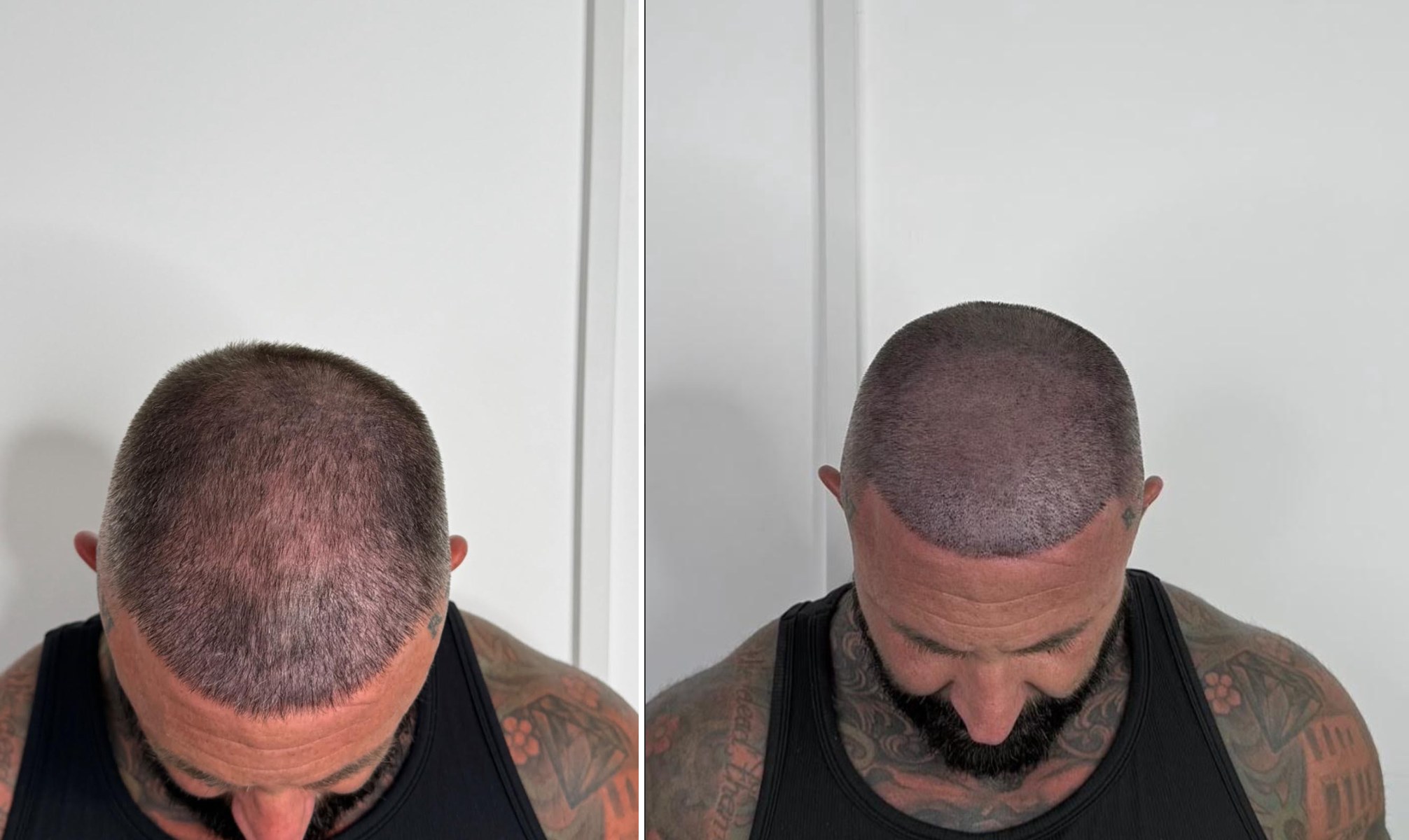 SMP before and after result